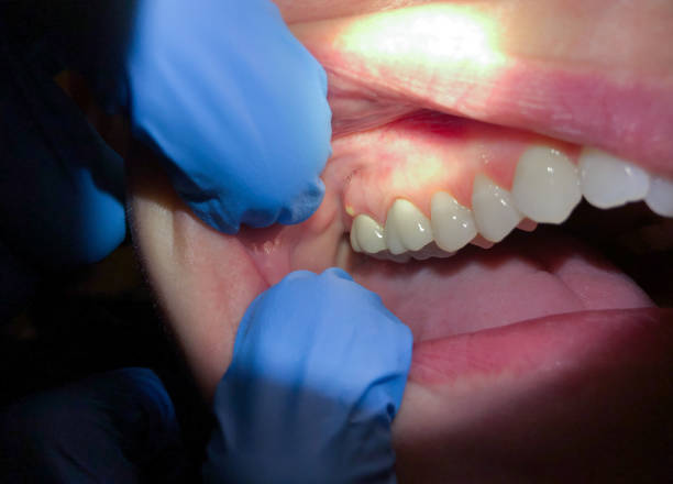 Best Emergency Gum Treatment in Plano, KY