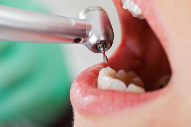 Best Emergency Wisdom Teeth Removal in Plano, KY